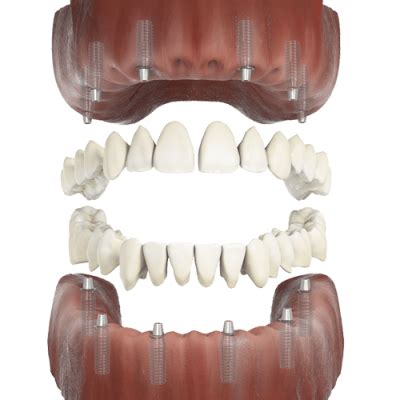 Fees | Hayes Dental Surgery | Dental implants, Affordable dental implants, Dental implant procedure