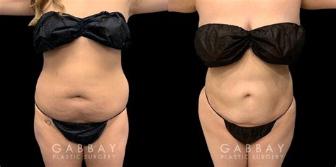 How to sleep after having a bbl procedure &am. Abdomen Lipo Before and After Photo Gallery | Gabbay ...