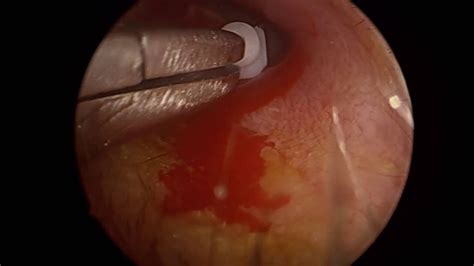Otitis media is an infection in the space behind the ear drum. Swimming After Grommets Fall Out