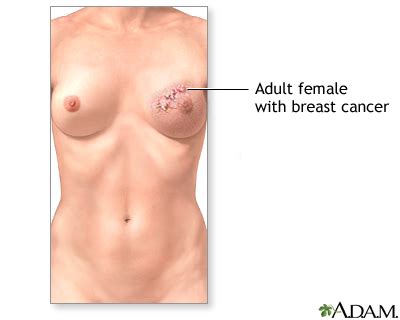 From the female cancer's perspective, more than what is on the surface, she weighs the quality of a prospective mate. Breast reconstruction - series: MedlinePlus Medical ...