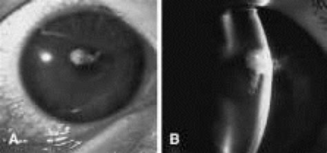Herpes simplex virus dendritic epithelial keratitis requires antiviral therapy, while hsv stromal keratitis typically similarly, a cornea believed to have hsv necrotizing keratitis may not always exhibit actual necrosis. Diagnosis and Management of Fungal Keratitis | Ento Key