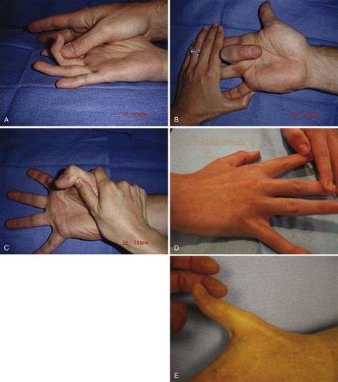 It can be anything but is commonly a Hand Surgery | Thoracic Key