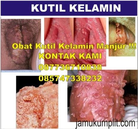 Joni indah sari ditinjau oleh dr. Penyakit Kuiti Kelamin Pada Pria | Obat Sipilis, Gonore, Kencing Nanah, dan Raja Singa