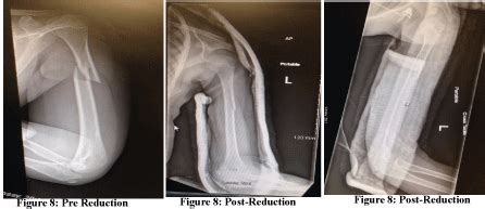 A Single-Provider Technique for the Closed Reduction of ...