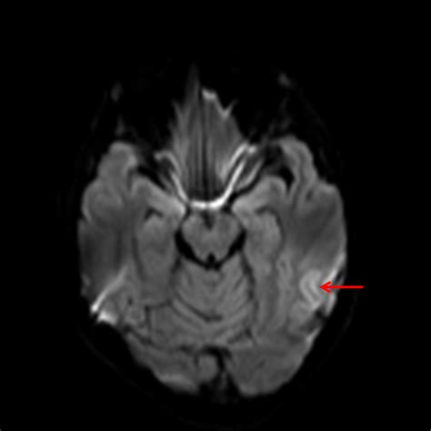 For the cerebral venous sinus thrombosis study group. CaseStacks.com — Case #3 — Venous sinus thrombosis