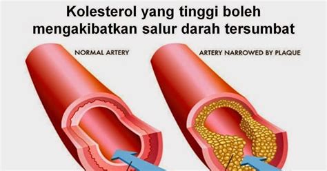 Tanda kolesterol tinggi adalah tidak spesifik dan belum tentu dirasakan semua orang. Tanda-tanda kolestrol tinggi dan cara mengatasinya ...