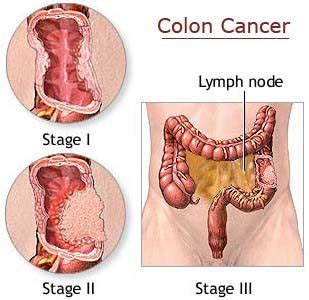Roberts wg, klein mk, loomis m, al et. Medical Lecture Notes Online: Colorectal cancer