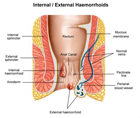 Complications of thrombosed external hemorrhoids. Best herbs for treating hemorrhoids (Piles)