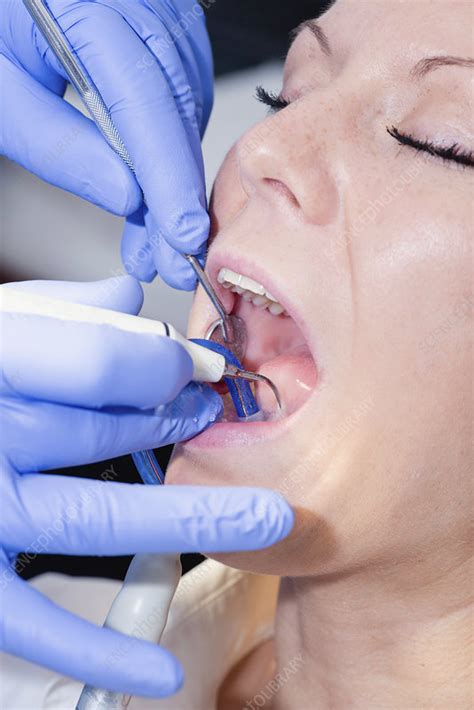 Did you know there are about 100 to 200 types of bacteria in your mouth at any given point in time? Removing dental tartar - Stock Image - F024/3991 - Science ...