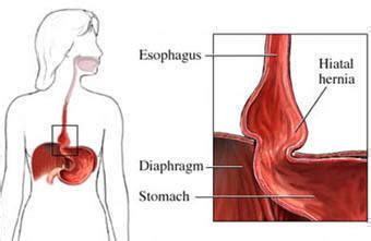 The chest wall is the structure that surrounds the vital organs within the thoracic cavity and consists of skin, fat, muscles, and bone (rib cage). Hiatal Hernia - www.headbacktohealth.com