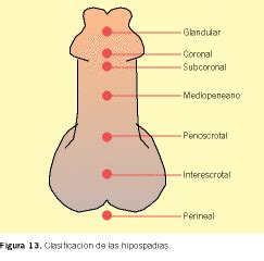 Meaning, pronunciation, synonyms, antonyms, origin, difficulty, usage index and more. Hipospadias