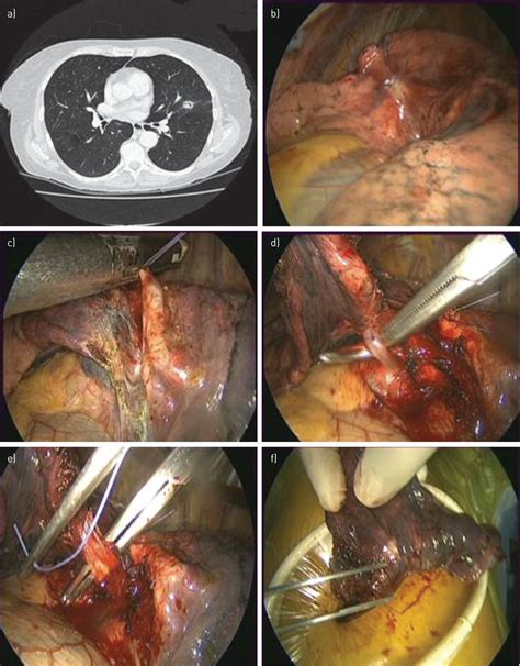 In this vlog on metastatic cancer, dr sue covers: Surgery for nonsmall cell lung cancer | European ...