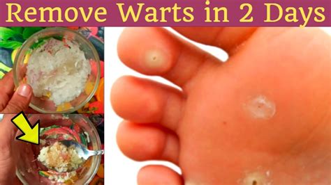 Why home tattoo removal can be dangerous. GET RID OF WARTS FAST - Best Home Remedies for Wart ...