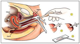 Ujian ini boleh dilakukan di semua klinik/hospital kerajaan dan swasta termasuk klinik lppkn (lembaga penduduk perancang keluarga negara) di. Klinik Ibnu A'Nafis: Ujian pap smear selamatkan wanita
