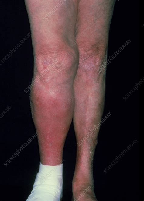 If you look at pictures of blood clots in leg, you will often see a red patch of skin. Deep vein thrombosis in the lower leg of a patient - Stock ...