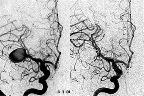 Cebral j.r., castro m.a., burgess j.e., pergolizzi r.s., sheridan m.j., putman c.m. Procedimientos neurorradiológicos - SENR: Bienvenid@ al ...