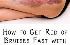 bruises rid women fast legs choose board skin bruise healthy umblr