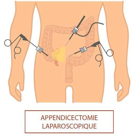 Symptoms commonly include right lower abdominal pain, nausea, vomiting, and decreased appetite. Appendicite de l'adulte - Symptômes et traitement - Doctissimo