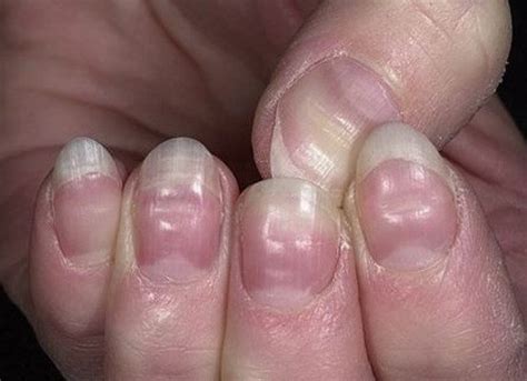 These tend to appear four weeks or more after a. 15 Health WARNINGS Your Fingernails Are Sending