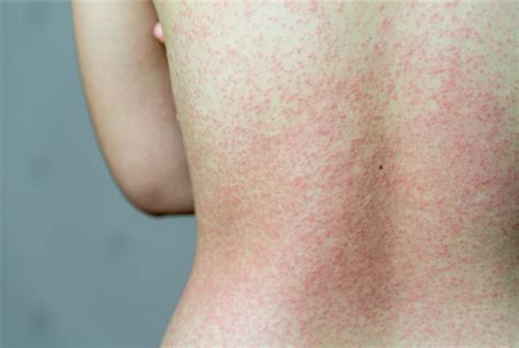 Itching (pruritus) is an unpleasant sensation where the skin signals a reflex response to tearing of the skin. How may coronavirus symptoms (COVID-19) manifest on the ...