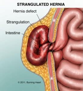 The hiatus is an organ in the diaphragm that keeps stomach contents from rising to where they should not be (it separates the chest cavity from the abdomen). Basic Hernia | Premier Hernia Center