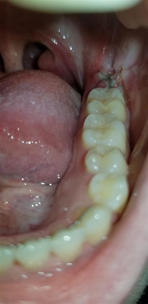 What does dry socket taste like? Does this look like dry socket? : wisdomteeth