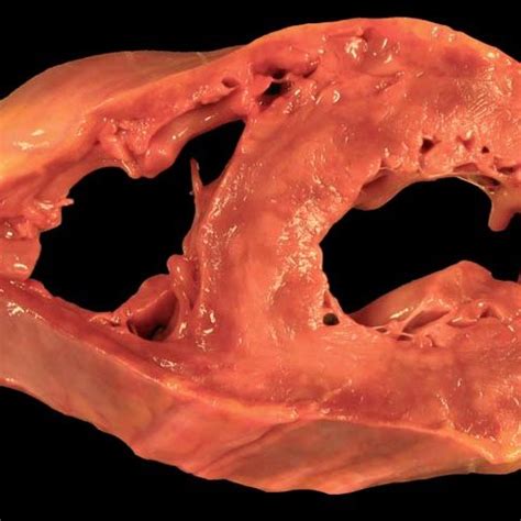 Tras su implantación en la práctica clínica, la resonancia magnética (rm) cardiaca se ha convertido en la mejor técnica diagnóstica no invasiva disponible para el diagnóstico de miocarditis aguda. (PDF) Miocarditis aguda y muerte súbita en jóvenes ...