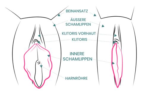 Bei der labioplastik werden meist die inneren schamlippen verkleinert. Schamlippenkorrektur (Labioplastik), Schamlippen ...