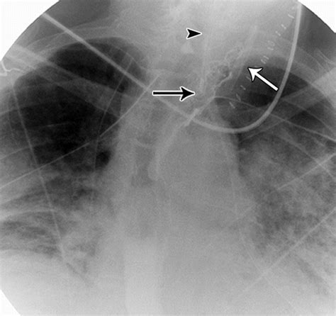 How is the esophagectomy performed at the cleveland clinic? Esophagectomy and Gastric Pull-through Procedures ...