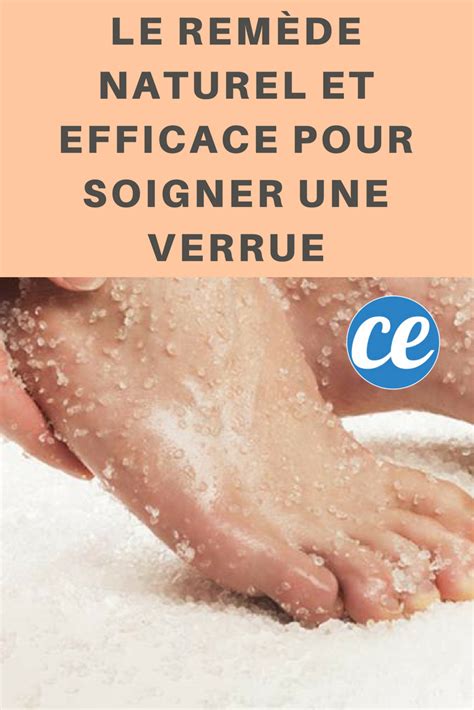 Le Remède Naturel et Efficace pour Soigner une Verrue. | Soigner une ...