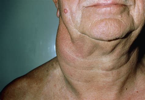 Painless swelling of one or more lymph nodes, with no recent infection. Hodgkin Lymphoma - Hematology and Oncology - MSD Manual ...