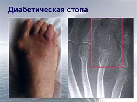 Диабетическая стопа диета