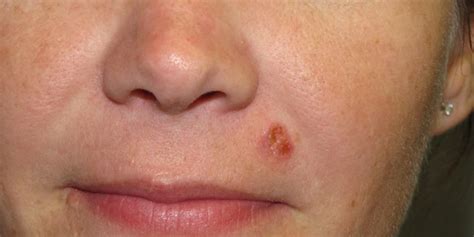 All skin cancer cells can spread to other parts of the body but this isn't common. Squamous Cell Carcinoma | Skin Cancer And Reconstructive ...
