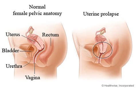 Biasanya, kedudukan rahim cenderung menjadi serenjang dengan pelvis. Wanita Yang Nak Hamil Perlu Elak Punca Yang Menyebabkan ...