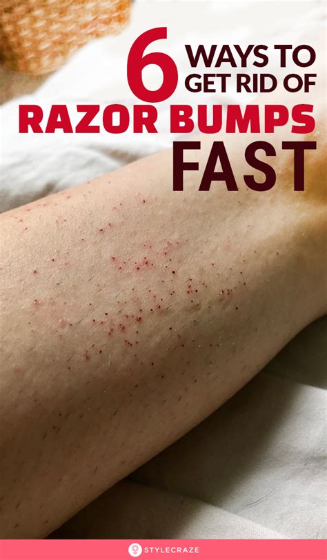 Coconut oil for getting rid of the bumps on the arms. 6 Ways To Get Rid Of Razor Bumps Fast in 2020 | Razor ...