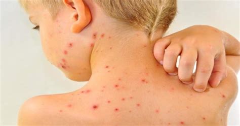 The itchy blister rash caused by chickenpox infection appears 10 to 21 days after exposure to the virus and usually lasts about five to 10 days. Chicken Pox symptoms Causes and prevention- Samayam Tamil ...