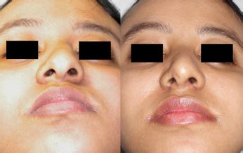 How to contour a crooked nose? Rhinoplasty (Nose Job) in Hyderabad & India|Nosecontour.com