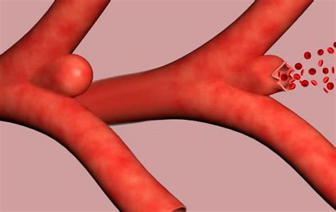 O que é, causas e sintomas. Definicion de aneurisma  2021 