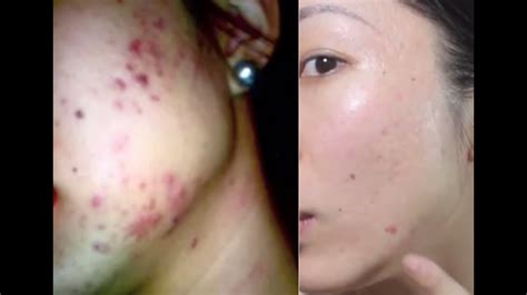 Beyond that time point, steroid injection, laser treatments or scar revision are helpful depending upon exactly what the scar issue happens to be. HOW TO REMOVE ACNE SCARS FOR UNDER $60!!! - YouTube