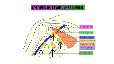 Inflammatory carcinoma (85303)—frequently involves entire breast and is characterized by reddened skin and edema caused by tumor spread to lymphatic channels of skin of breast, usually without an underlying palpable mass. Lymphatic Drainage of Breast --MRCS PART A review - YouTube