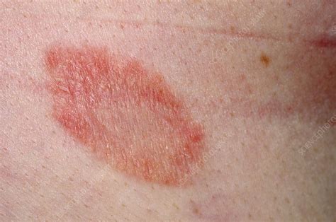 Bathe or shower in lukewarm water. Herald patch in pityriasis rosea - Stock Image - C014/2707 ...