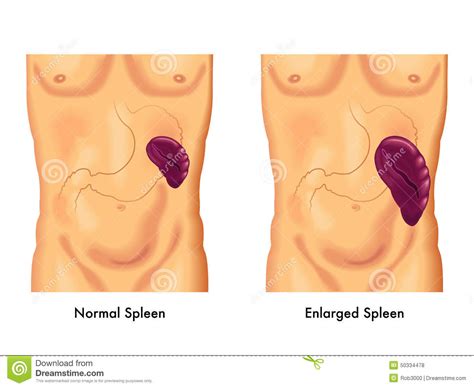 Instead, you'll receive treatment for any underlying condition and. Enlarged Spleen Stock Photo - Image: 50334478