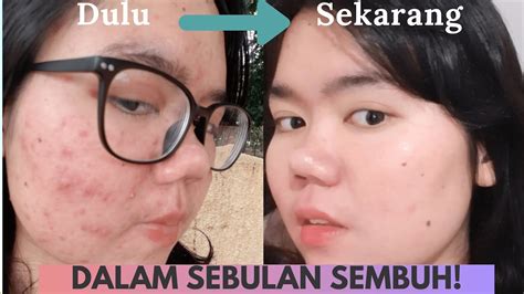 We did not find results for: CARA MENGHILANGKAN JERAWAT BATU DENGAN CEPAT! KEHEBATAN ...