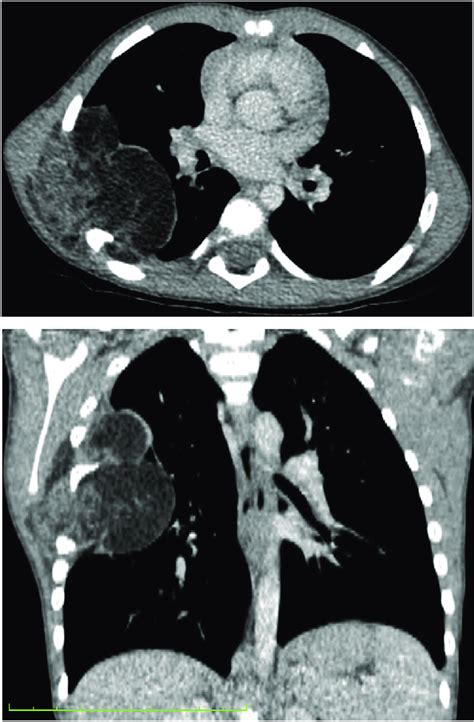 Parallel to the supraspinatus muscle & tendon or perpendicular to the glenoid. Contrast enhanced CT Images in axial and coronal planes ...