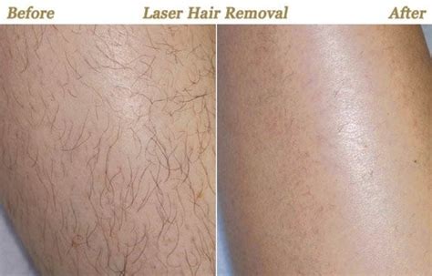 When you shave the treatment area, you also superficially exfoliating the skin and this may cause some sensitivity. Which is the best doctor for permanent laser hair removal ...