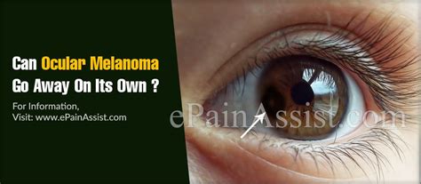 The chances of cancer disappearing with no treatment, are about 1 in 80,000 to about 1 in 100,000. Can Ocular Melanoma Go Away On Its Own & What Are Its ...