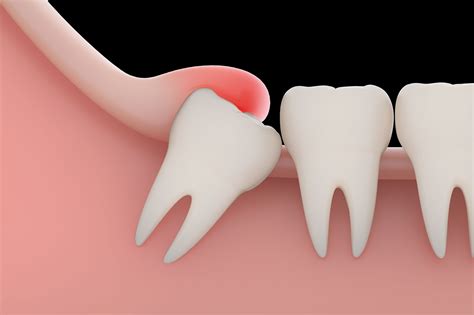 This was a big issue for my family because my brother's wisdom teeth removal cost over $3,000 and insurance would this means that they prepare medications to go to the general market. How to Prepare for Wisdom Teeth Removal?