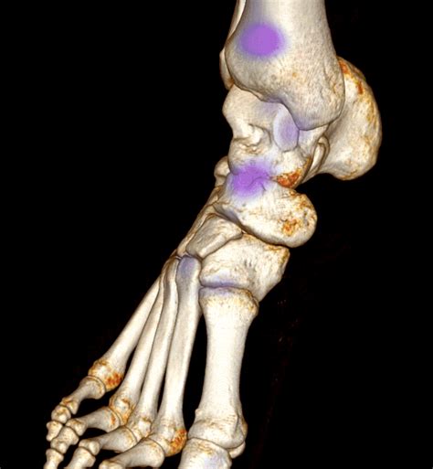 Case of the week: Bone SPECT-CT dorsal navicular stress ...