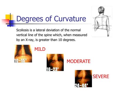 Scoliosis degrees of curvature chart www bedowntowndaytona com. PPT - Scoliosis Screening PowerPoint Presentation - ID:826673