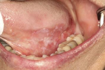 Erythroleukoplakia is a erythroplakia is the clinical diagnostic term for a chronic red mucosal macule which cannot be given another specific. Leukoplakia—A Diagnostic and Management Algorithm ...